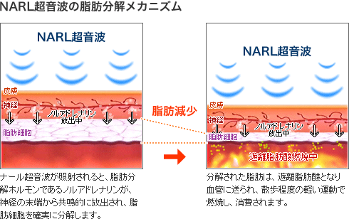 ナール超音波（NARL超音波 517）が、驚きの痩身効果を発揮